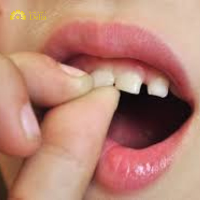 Răng lung lay nhưng không đau nguyên nhân vì sao, cần làm gì?