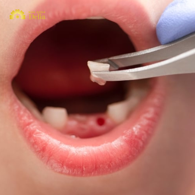 Răng sâu như thế nào thì phải nhổ? Dấu hiệu cần nhổ răng sớm
