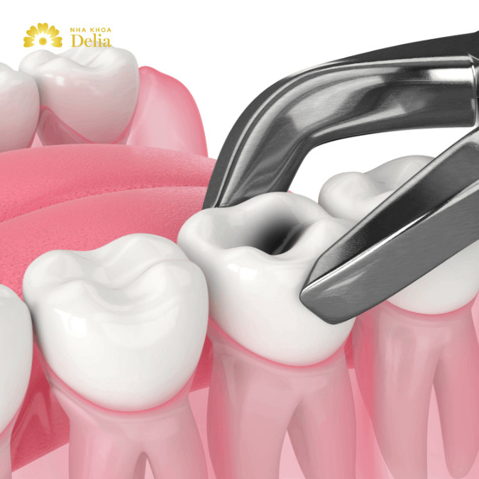 Răng số 6 bị sâu có nên nhổ không? Đừng vội vàng quyết định