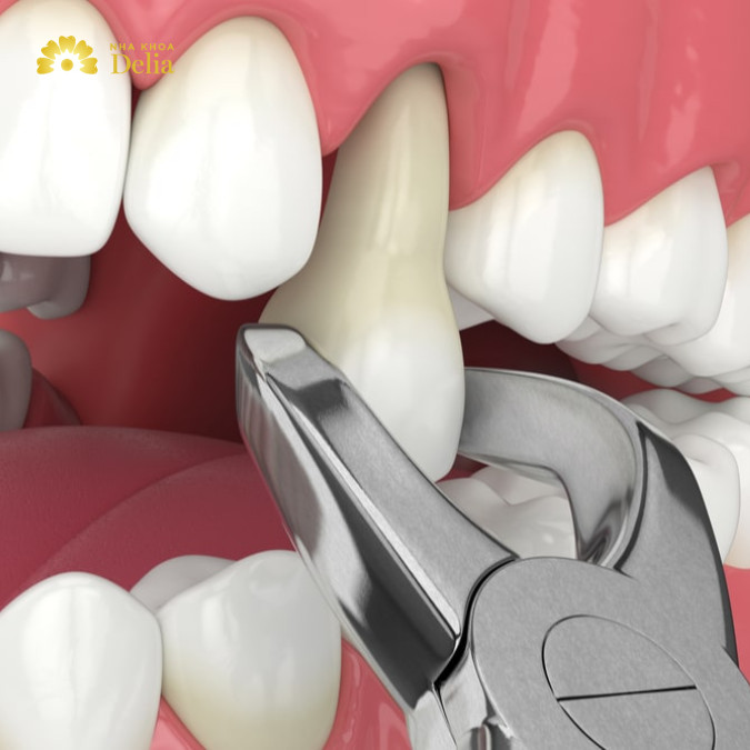 Răng số 7 bị sâu có nên nhổ không? Cân nhắc kỹ lưỡng kẻo hối hận