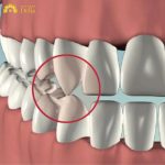 Nguyên nhân hàng đầu khiến răng nanh mọc lệch trở thành răng khểnh là do di truyền