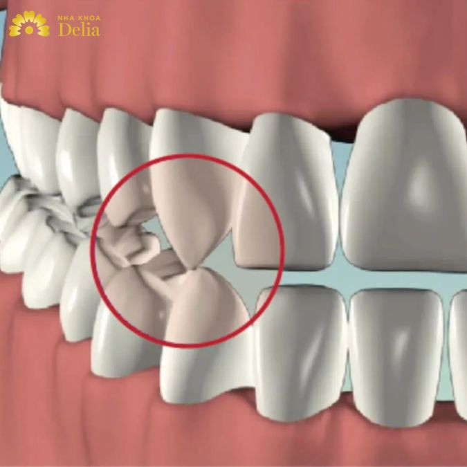 Răng nanh mọc lệch có nghiêm trọng không, cần làm gì?