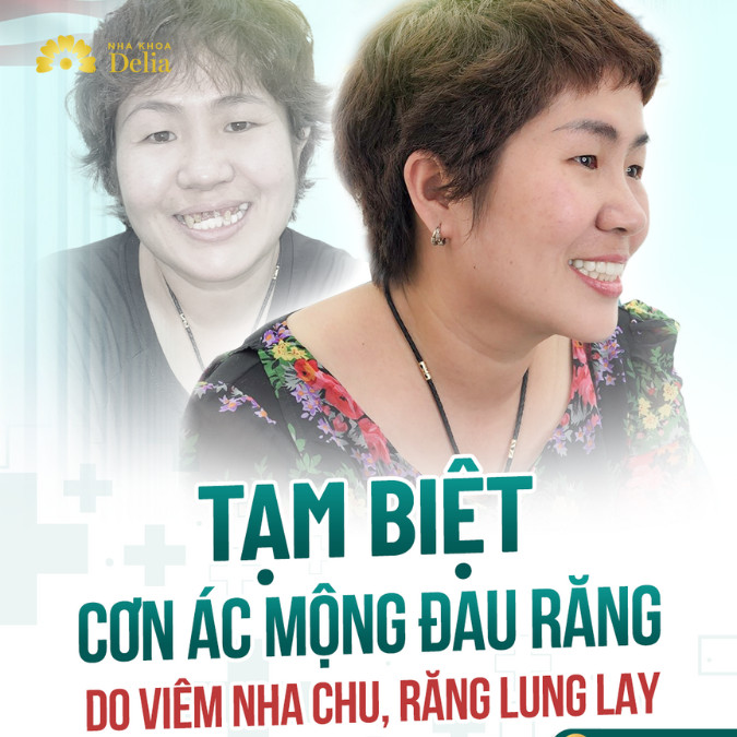 Tạm biệt cơn ác mộng đau răng do viêm nha chu, răng lung lay – KH Lê Hải