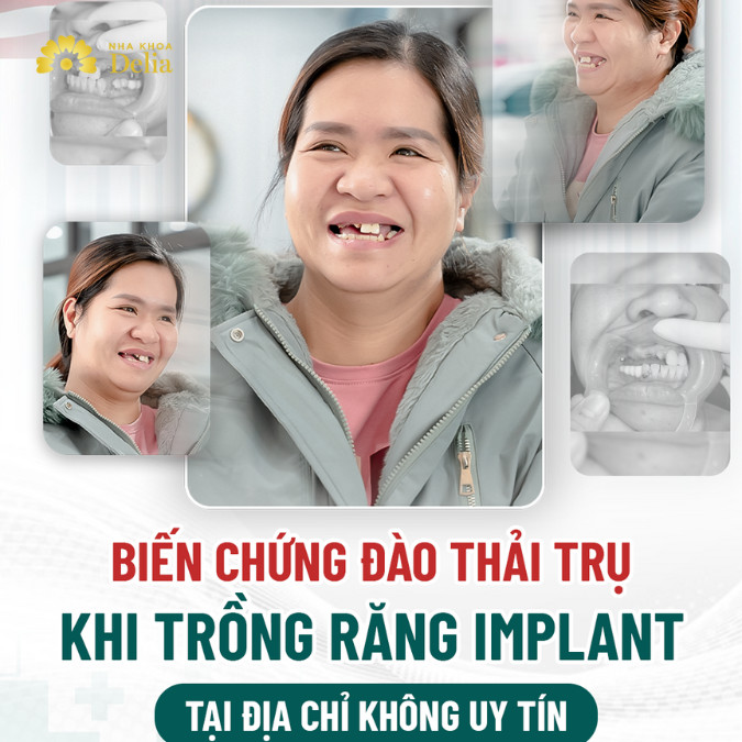 Trụ Implant bị đào thải do trồng răng siêu rẻ ở quê nhà – KH Quỳnh Trang
