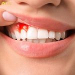 Hút thuốc lá cũng là nguyên nhân làm giảm lưu lượng máu đến nướu, khiến nướu dễ bị tổn thương và viêm nhiễm