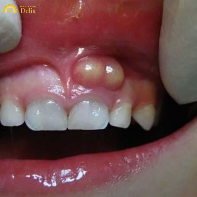 Tất tần tật về viêm lợi có mủ: Nguyên nhân, cách điều trị