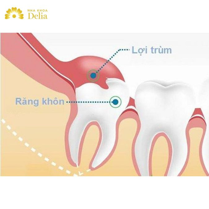 Làm sao để phát hiện viêm lợi trùm? Cách điều trị dứt điểm ra sao?