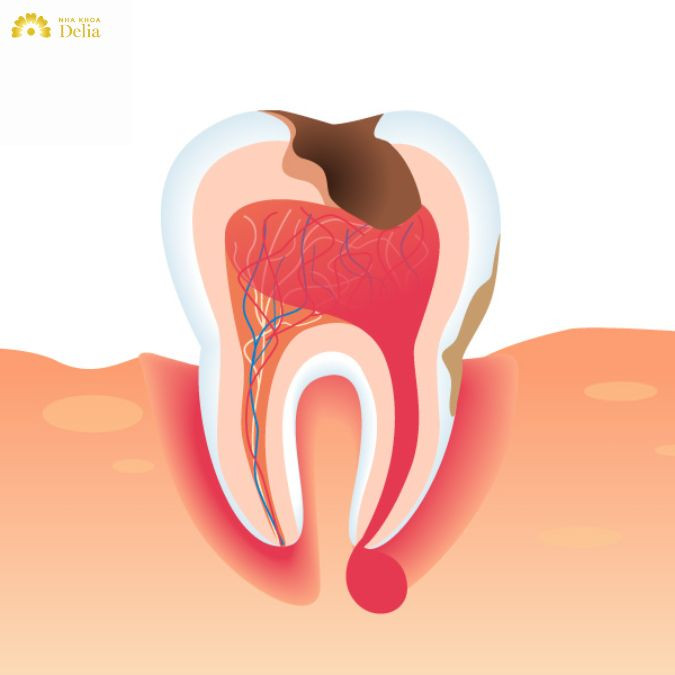 Trả lời thắc mắc cùng Delia: Áp xe chân răng có nguy hiểm không?