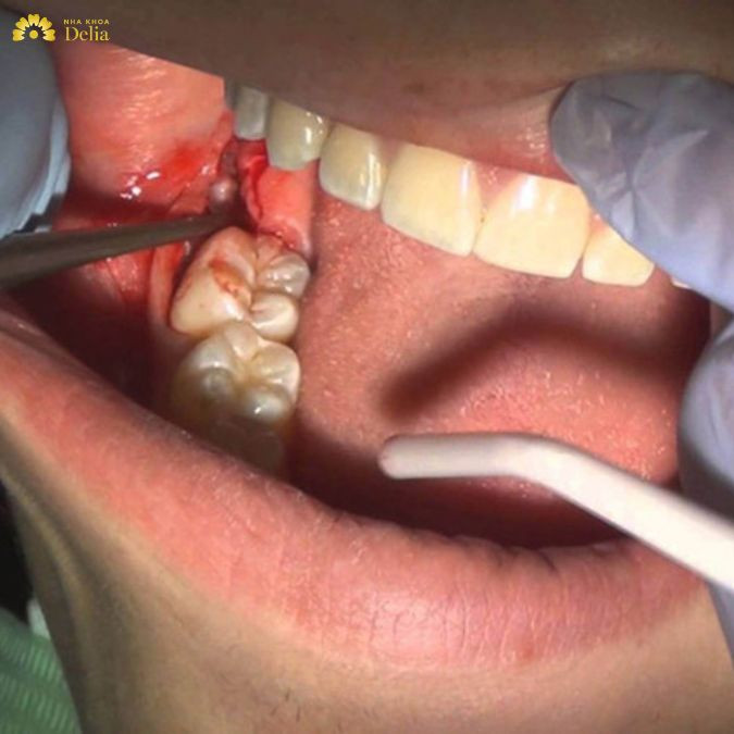 Viêm chân răng hàm dưới có thật sự nguy hiểm, nguyên nhân – Cách khắc phục