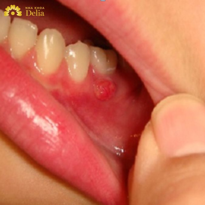 Làm thế nào để nhận biết áp xe răng hàm dưới? Chữa trị như nào?
