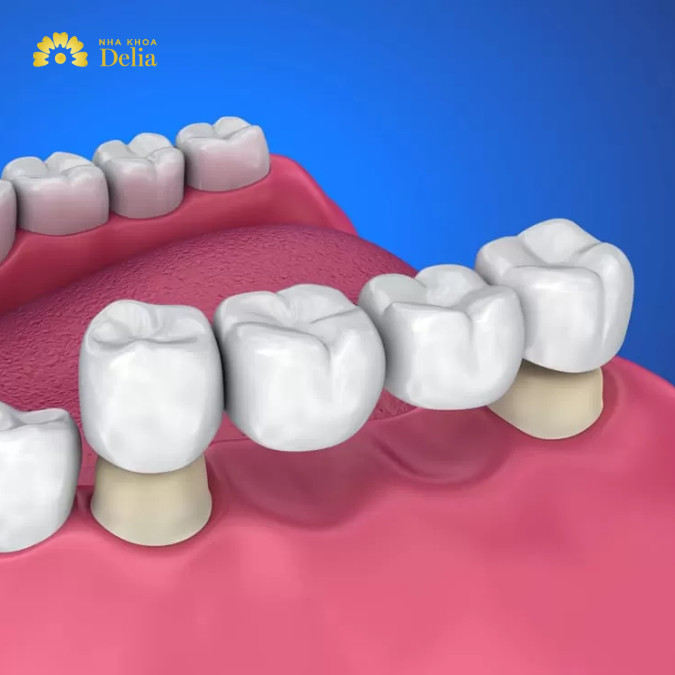 Bắc cầu răng sứ có bền không dùng được bao lâu thì phải thay?