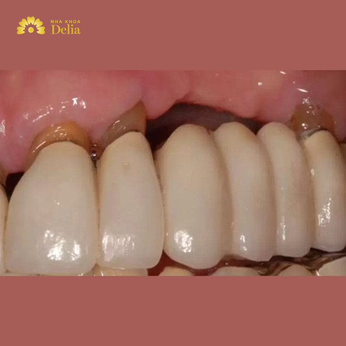 Cẩn trọng với những dấu hiệu cầu răng sứ bị hở
