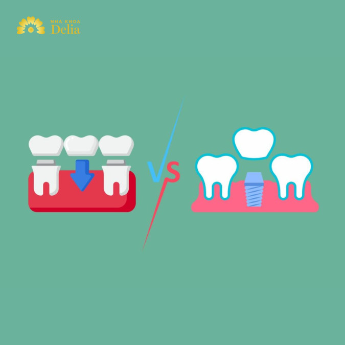 So sánh cầu răng và Implant, đâu mới là giải pháp phù hợp