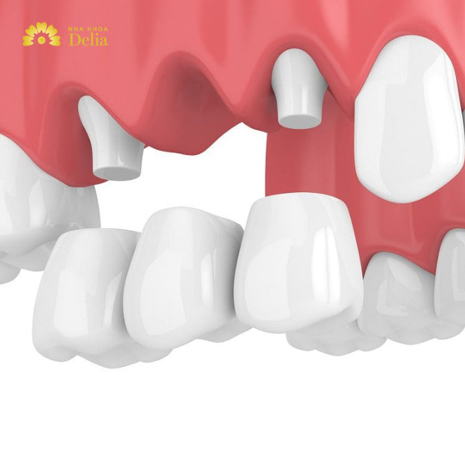 Có nên làm cầu răng sứ? Đánh giá chi tiết ưu nhược điểm