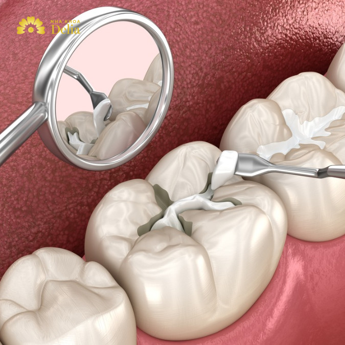 Composite trám răng là gì? Dùng có bền không, bao lâu cần thay