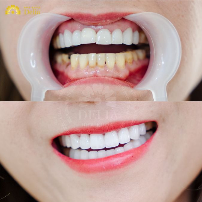 Composite veneers or porcelain veneer teeth – which is better?