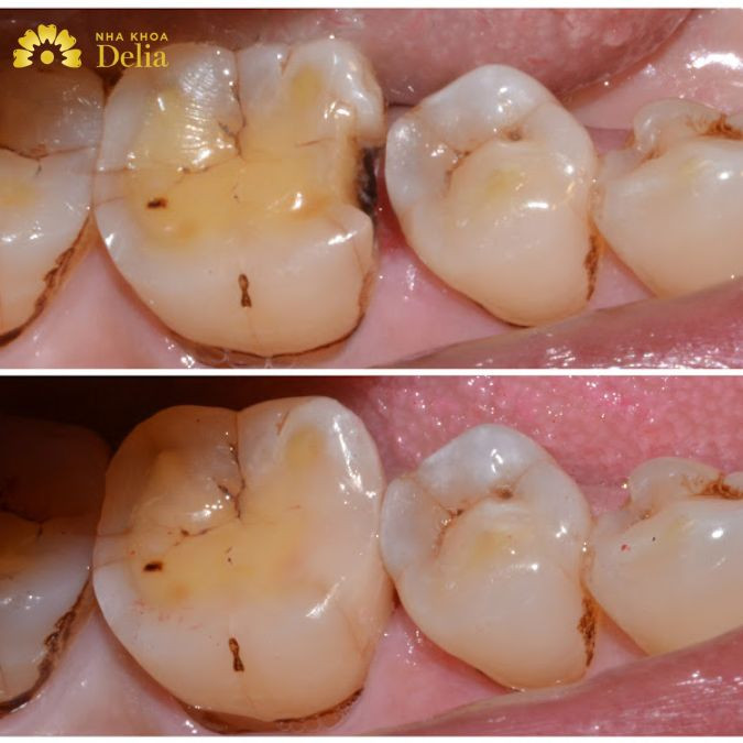 What is dental composite filling? Are composite dental filling materials durable?