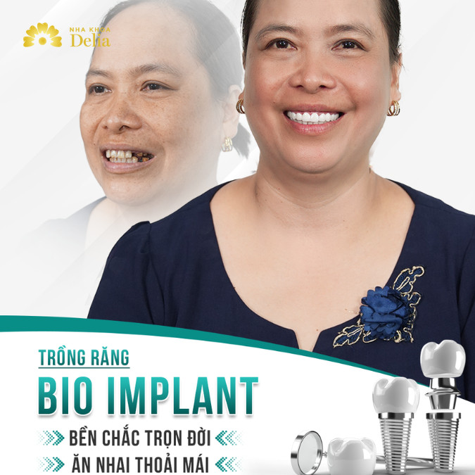 Hành trình trồng răng Implant cho KH mất 7 răng, kết hợp sâu, vỡ răng – KH Nguyễn Hoa Lý
