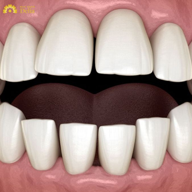 Đâu là giải pháp tốt nhất cải thiện khớp cắn hở?