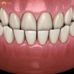 So với xương hàm dưới, xương hàm trên nếu nhỏ hơn sẽ khiến răng cửa hàm trên nằm chếch ra sau răng cửa hàm dưới