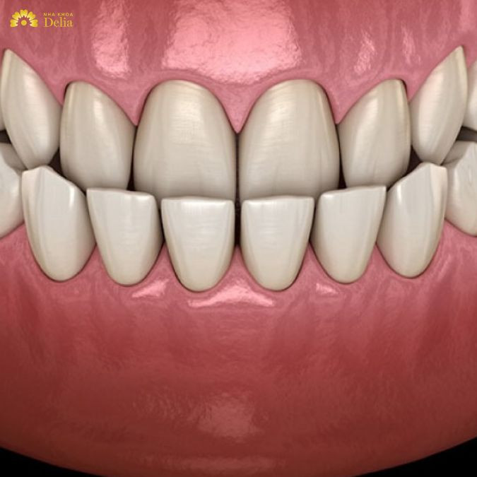 Khớp cắn ngược là gì? Làm thế nào để khắc phục ngược khớp cắn?