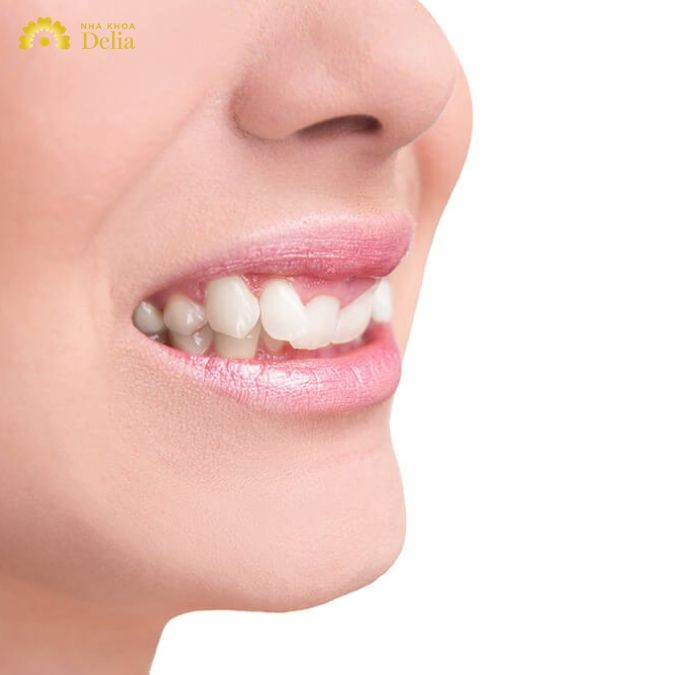 Đâu là giải pháp cải thiện hoàn hảo nhất khớp cắn sâu?