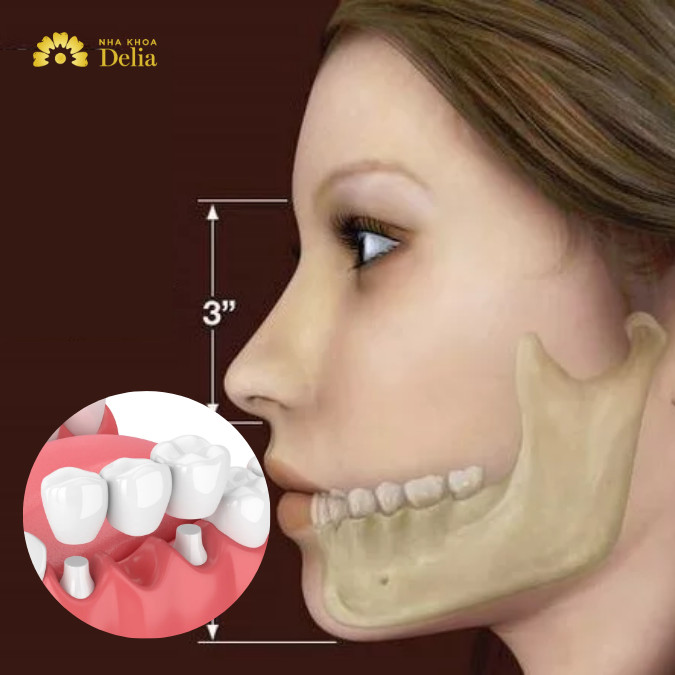 Làm cầu răng có bị tiêu xương không? Tác động của cầu răng đến xương hàm