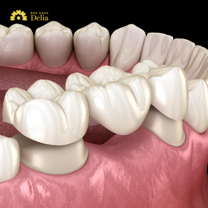 Có nên làm cầu răng số 6 không? Review chi tiết quy trình thực tế