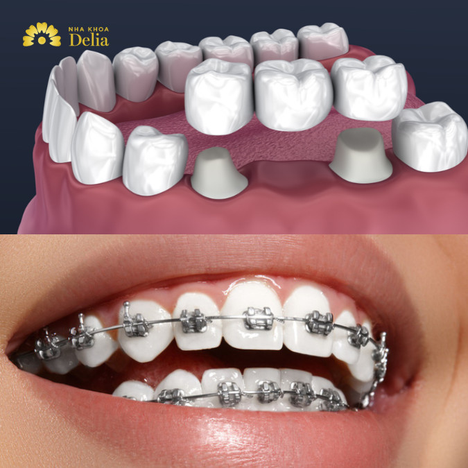 Làm cầu răng sứ có niềng răng được không? Bác sĩ giải đáp