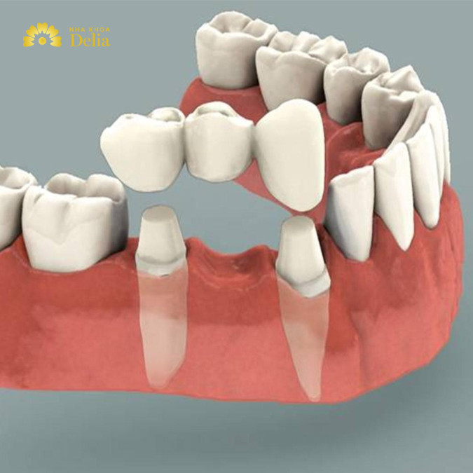 Làm cầu răng sứ giá bao nhiêu? Bảng giá cập nhật 2024