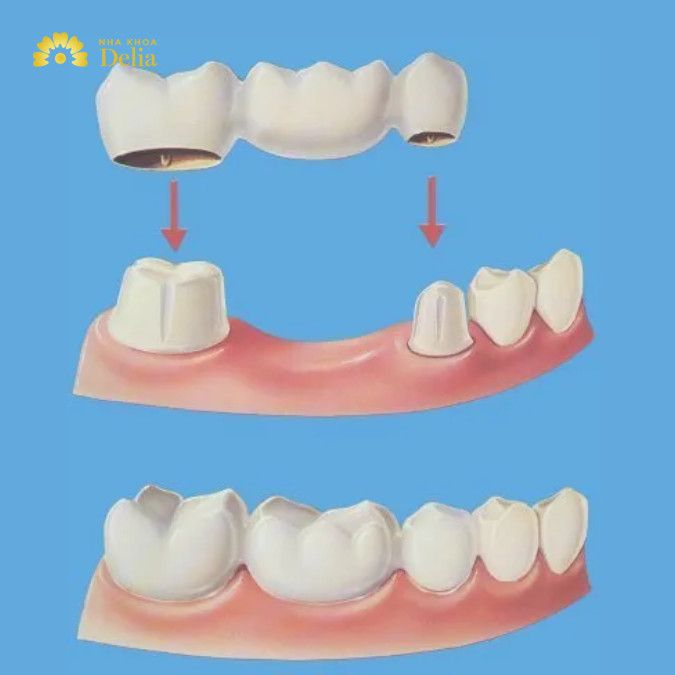 Làm cầu răng sứ mất bao lâu? Hiểu rõ về quy trình và yếu tố ảnh hưởng