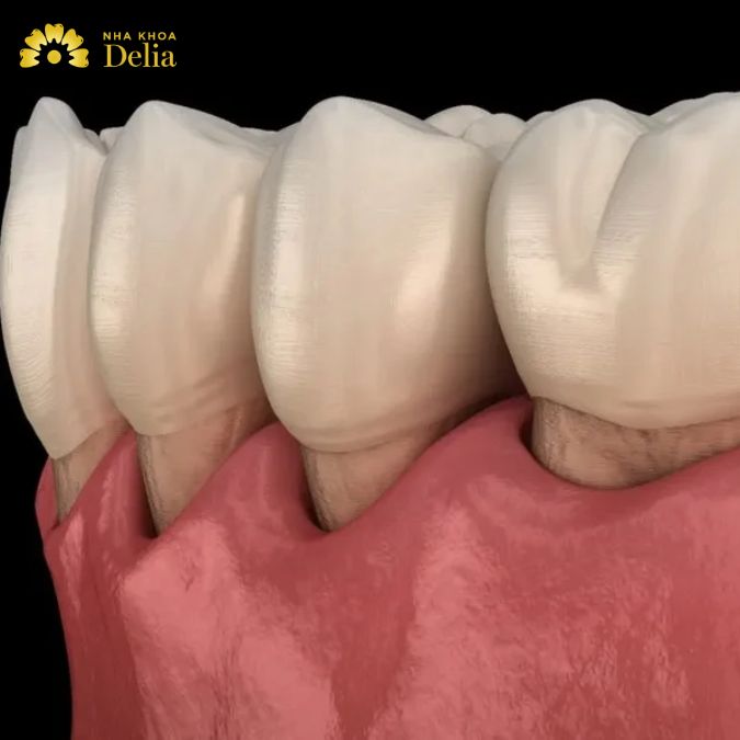 Kiểm chứng LỜI ĐỒN lấy cao răng xong bị tụt lợi?