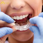 Nếu không đeo máng, nghiến răng lâu dài sẽ khiến men răng bị bào mòn, đau nhức cơ hàm