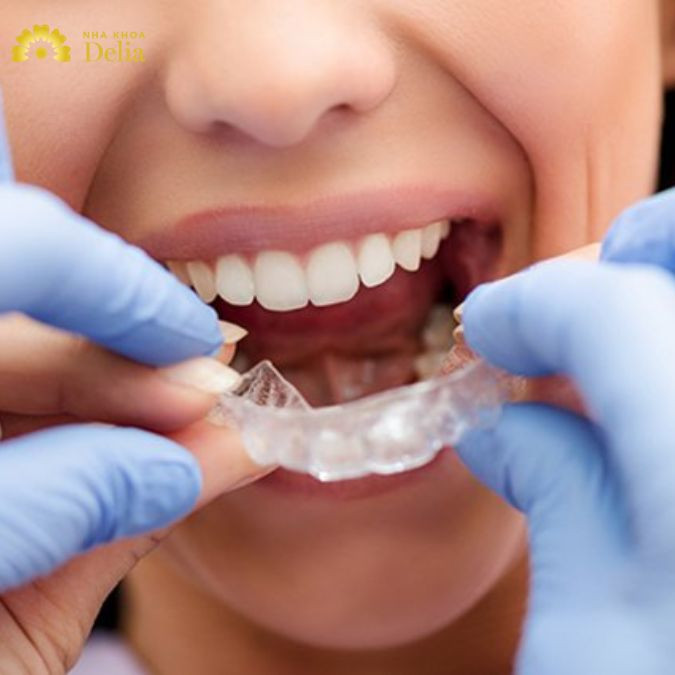 Máng chống nghiến răng có nên dùng không? Sử dụng như nào?