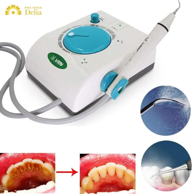 Có nên dùng máy cạo vôi răng tại nhà? Hiệu quả không?