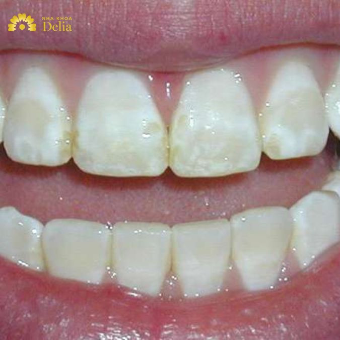 Men răng yếu do đâu? Men răng yếu phải làm sao???