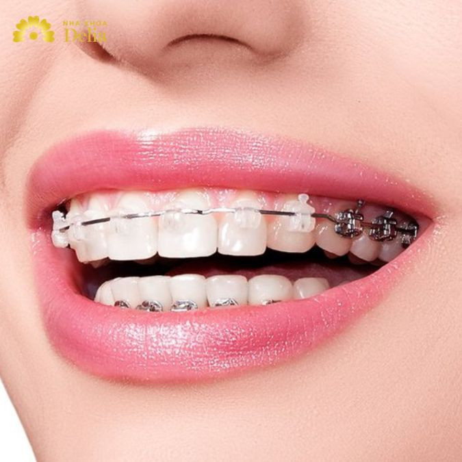 Nâng khớp cắn khi niềng răng nên không? Khi nào?