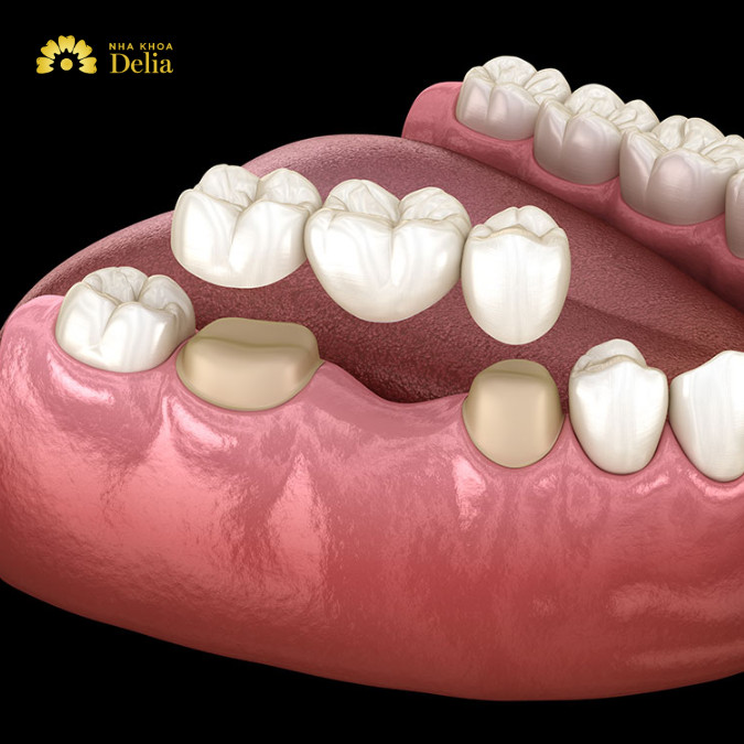 5 nhược điểm của cầu răng sứ, cẩn trọng với những biến chứng tiềm ẩn