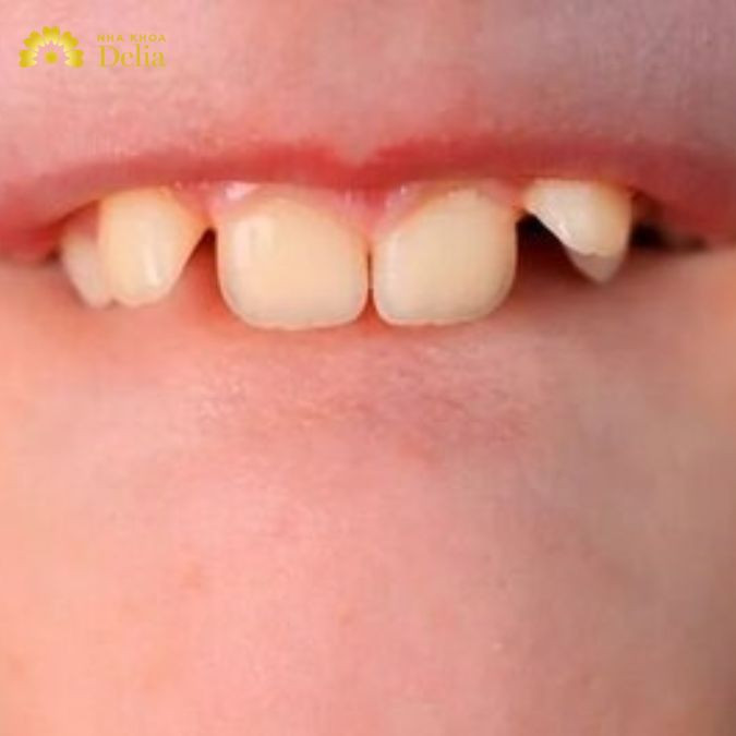 Răng chuột là răng như thế nào? Cách cải thiện răng chuột đẹp nhất