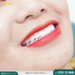 Răng cửa là những chiếc răng đầu tiên xuất hiện khi cười hoặc giao tiếp