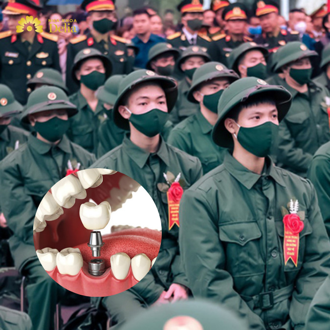 Răng giả có đi nghĩa vụ không, tiêu chuẩn khám nghĩa vụ cho răng là gì?