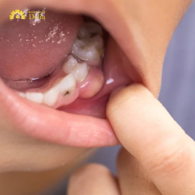 Sưng mộng răng là như thế nào, có nguy hiểm không?