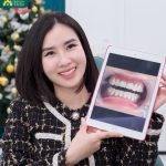 Với hình thể và màu sắc răng không đẹp, bác sĩ tại Delia đã tư vấn chị bọc răng sứ Ceramill