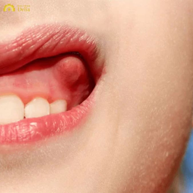 Chia sẻ phác đồ điều trị áp xe răng tại nha khoa Delia