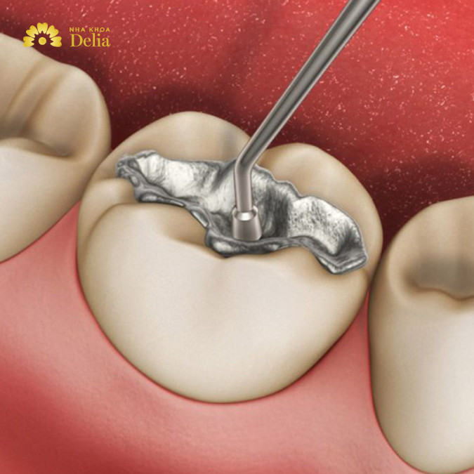 Trám răng Amalgam là như thế nào? Có an toàn không?