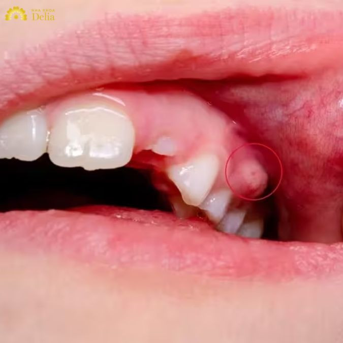 Có nên trị áp xe răng tại nhà không? Phương pháp nào tốt nhất?