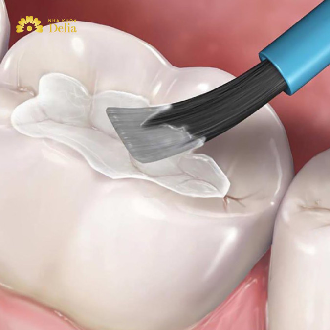 Vật liệu trám răng GIC có vĩnh viễn không, ai nên dùng?