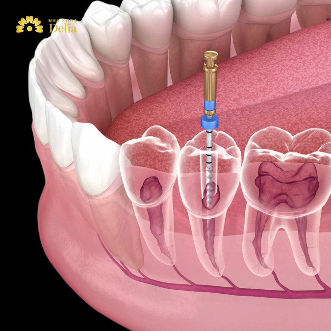 Cấy tủy răng nhân tạo là như thế nào, có hiệu quả không?