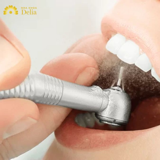 Mức giá cạo vôi răng và đánh bóng đắt hay rẻ? Có nên làm không?
