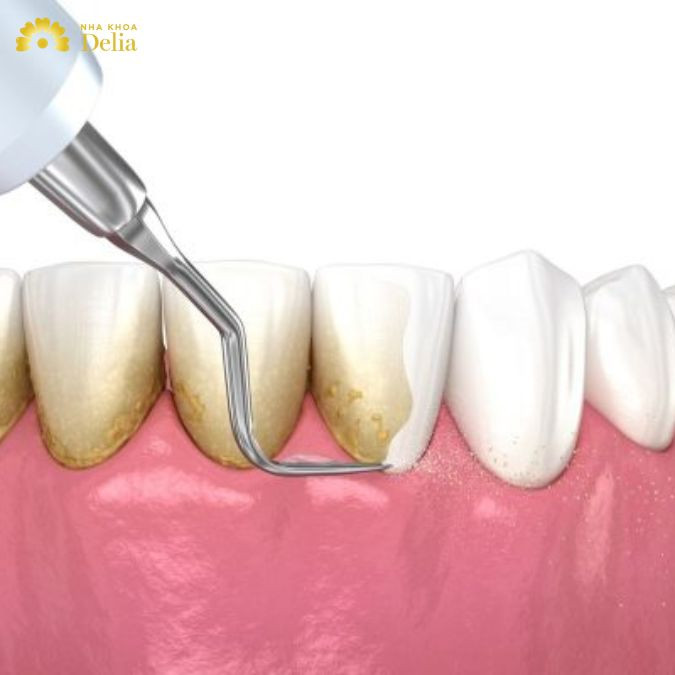 Bao lâu lấy cao răng 1 lần? Có nên cạo cao răng thường xuyên?